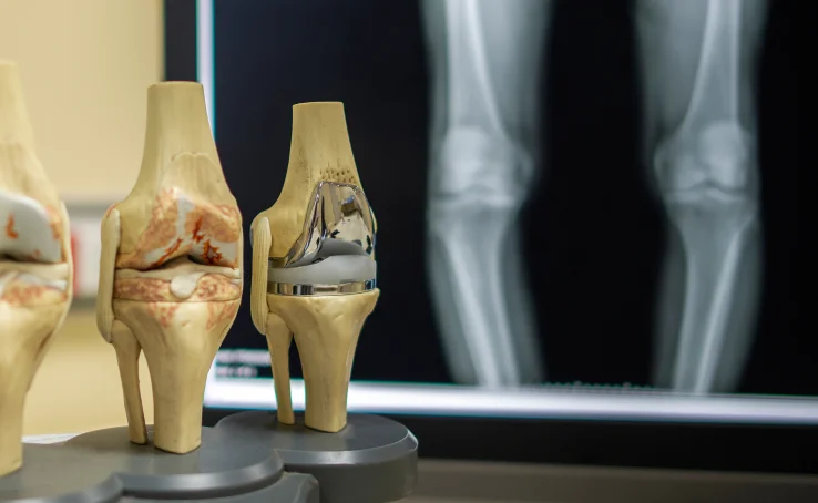 knee-replacement-surgery